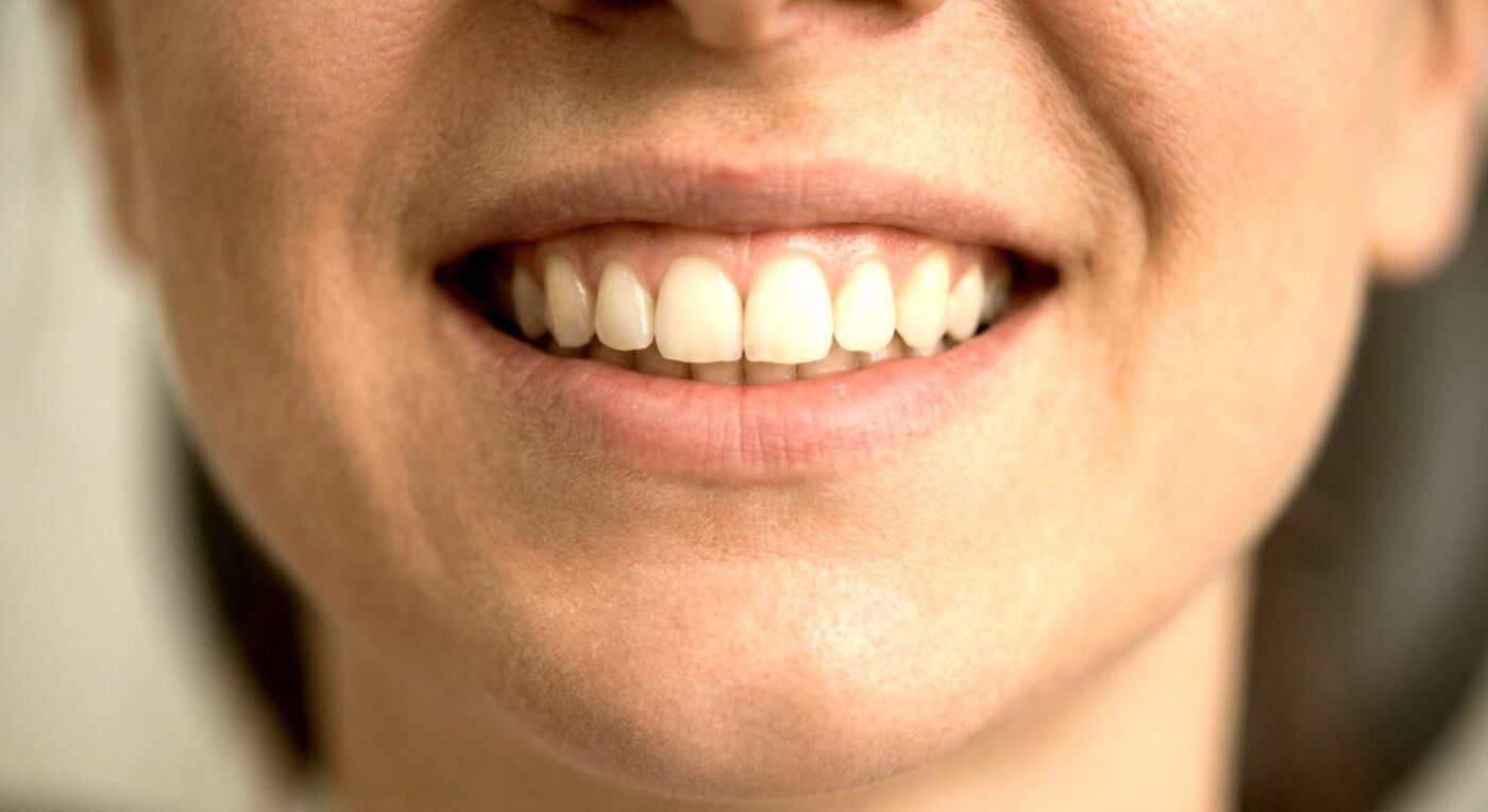 Estado inicial de la sonrisa antes del tratamiento